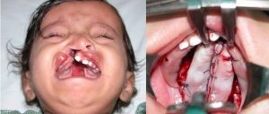 Primary Cleft Palate