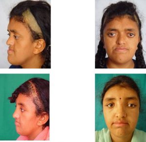 Deformities severe facial Goldenhar Syndrome