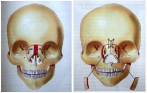 SKULL DEFORMITIES – Inga Health Foundation